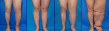 Linfedema