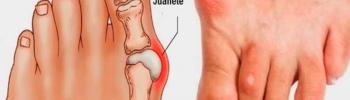 Tratamiento para el Hallux Valgus Tratamiento para el Hallux Valgus