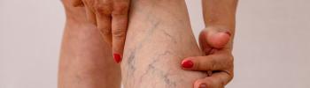 Problemas de circulación y varices: soluciones desde la fisioterapia