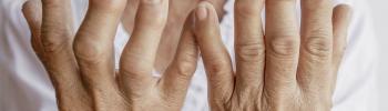 Artritis reumatoidea