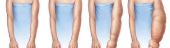 Linfedema tratamiento en casa