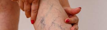 Fisioterapia vascular: Cómo prevenir complicaciones tras una trombosis Fisioterapia vascular: Cómo prevenir complicaciones tras una trombosis