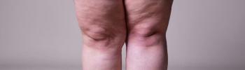 Lipedema piernas Lipedema piernas