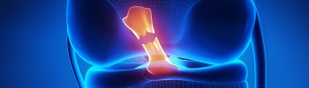 Cómo manejar la inestabilidad de la rodilla tras una rotura de ligamentos cruzados Cómo manejar la inestabilidad de la rodilla tras una rotura de ligamentos cruzados
