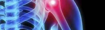 Tratamiento sindrome desfiladero torácico Bilbao