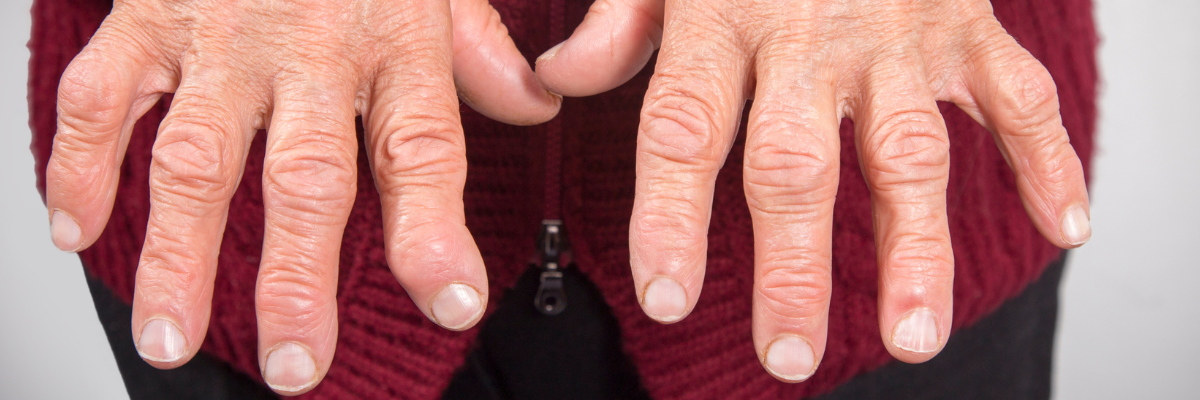 La fisioterapia como parte integral del tratamiento para la artritis