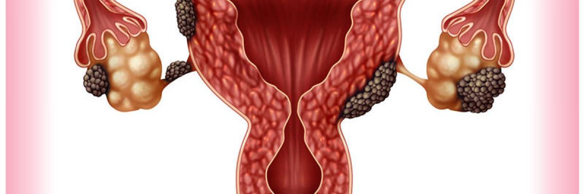 Endometriosis conceptos integrativos