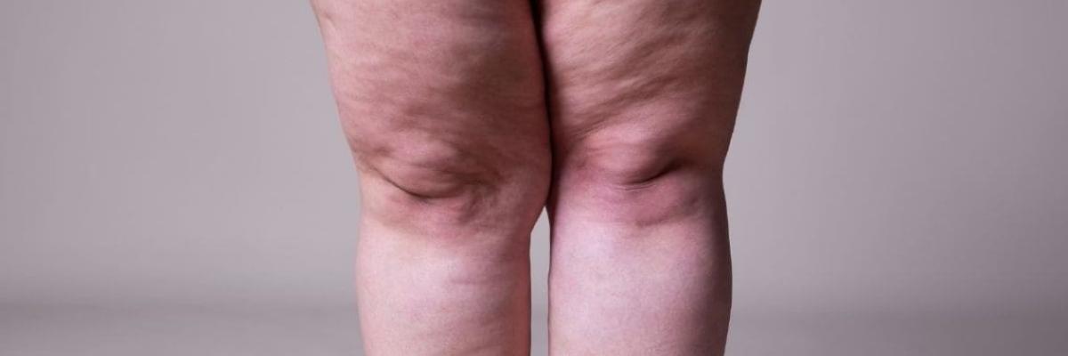 Lipedema piernas