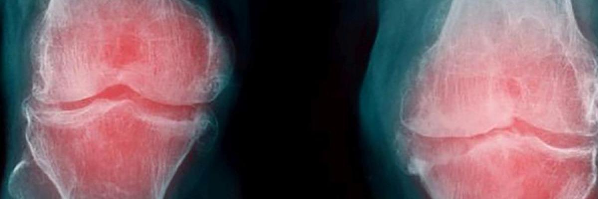 Tratamiento mediante la fisioterapia para la artrosis de rodilla y cadera - FisioClinics Bilbao