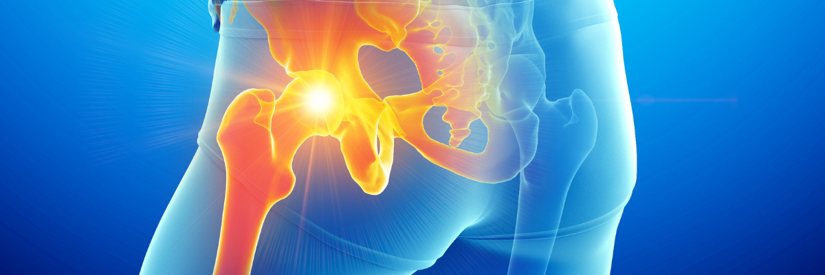 Artrosis de cadera, síntomas y cómo prevenirla