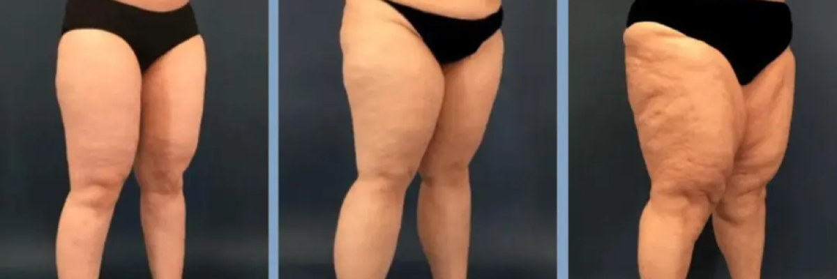 Método Godoy pre y post quirúgico