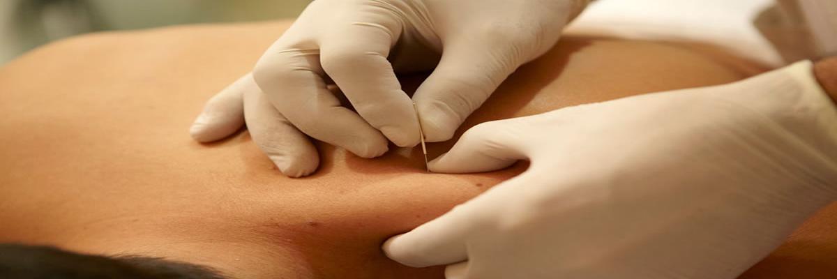 Punción seca para el tratamiento de los puntos gatillo