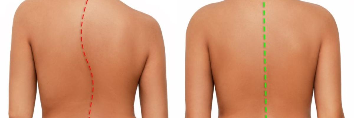 Quiropraxia y fisioterapia combinadas en escoliosis leve excluyendo cirugía