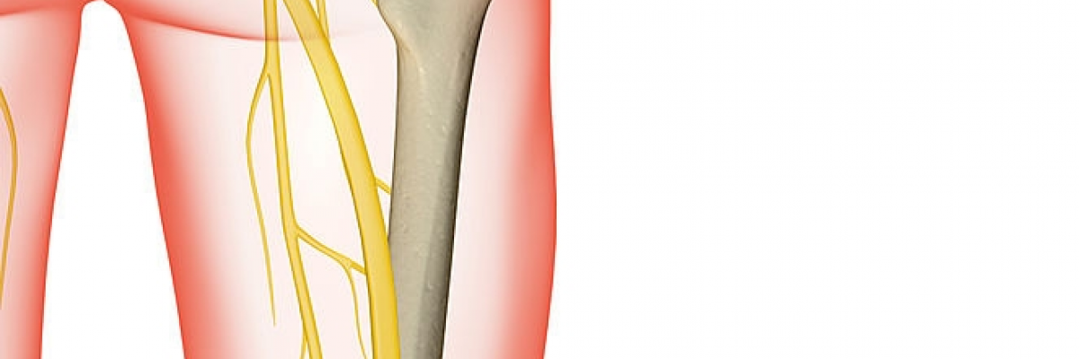 Terapia manual como tratamiento para la ciática