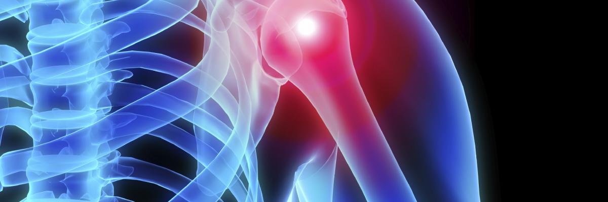 Tratamiento sindrome desfiladero torácico Bilbao