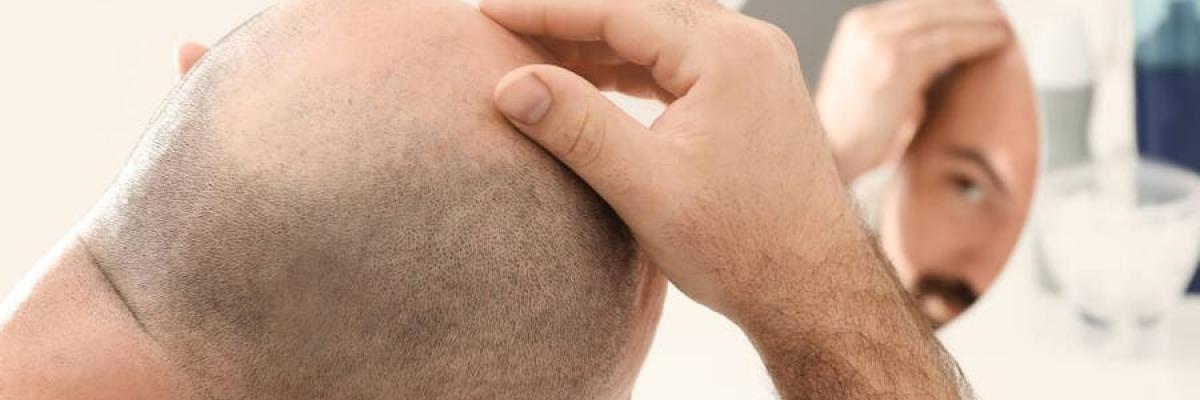 Alopecia: Que es, causas y tratamiento en FisioClinics Bilbao